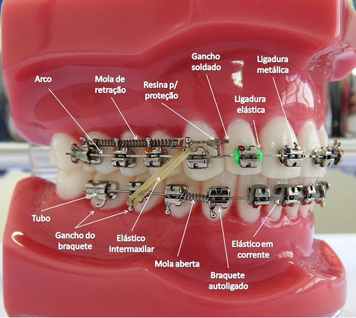 Fases do Tratamento AOrtodontia Fases do Tratamento AOrtodontia